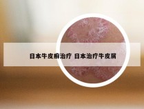 日本牛皮癣治疗 日本治疗牛皮屑