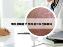 银屑病嘴角烂 银屑病会长在嘴角吗