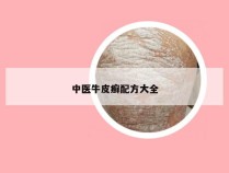 中医牛皮癣配方大全