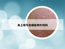 身上有牛皮癣能喝牛奶吗