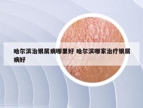 哈尔滨治银屑病哪里好 哈尔滨哪家治疗银屑病好