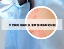 牛皮癣与体癣区别 牛皮屑和体癣的区别