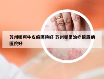 苏州哪所牛皮癣医院好 苏州哪里治疗银屑病医院好