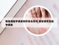 银屑病指甲病变和肝有关系吗 银屑病导致指甲病变