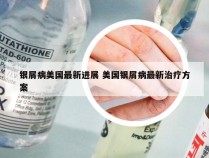 银屑病美国最新进展 美国银屑病最新治疗方案