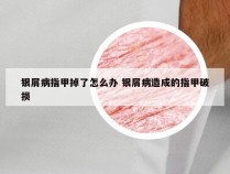 银屑病指甲掉了怎么办 银屑病造成的指甲破损