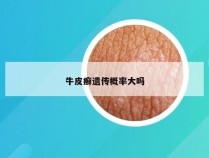 牛皮癣遗传概率大吗