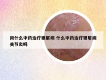 用什么中药治疗银屑病 什么中药治疗银屑病关节炎吗