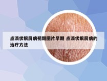 点滴状银屑病初期图片早期 点滴状银屑病的治疗方法