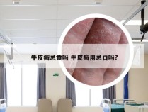 牛皮癣忌黄吗 牛皮癣用忌口吗?