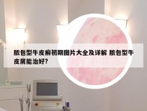 脓包型牛皮癣初期图片大全及详解 脓包型牛皮屑能治好?