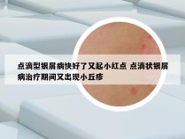 点滴型银屑病快好了又起小红点 点滴状银屑病治疗期间又出现小丘疹