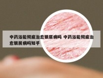 中药浴能彻底治愈银屑病吗 中药浴能彻底治愈银屑病吗知乎