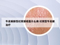 牛皮癣肤性红斑狼疮是什么病 红斑型牛皮廨治疗