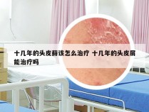 十几年的头皮藓该怎么治疗 十几年的头皮屑能治疗吗