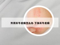 外阴长牛皮癣怎么办 下体长牛皮癣