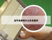 治牛皮癣用什么乳膏最好