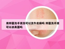 用抑菌洗手液洗可以洗牛皮癣吗 抑菌洗手液可以杀真菌吗
