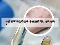 牛皮癣可以吃鸡精吗 牛皮肤癣可以吃鸡肉吗?