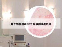 那个银屑病看不好 银屑病谁看的好