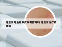 龙爪菊对治疗牛皮癣有作用吗 龙爪菊治疗皮肤病