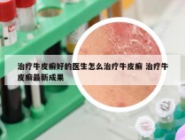 治疗牛皮癣好的医生怎么治疗牛皮癣 治疗牛皮癣最新成果
