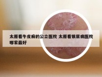 太原看牛皮癣的公立医院 太原看银屑病医院哪家最好