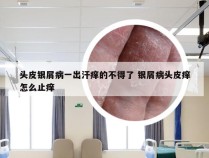 头皮银屑病一出汗痒的不得了 银屑病头皮痒怎么止痒