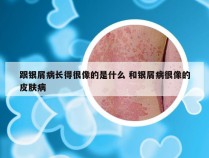 跟银屑病长得很像的是什么 和银屑病很像的皮肤病