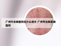 广州牛皮癣医院在什么地方 广州专治银屑病医院