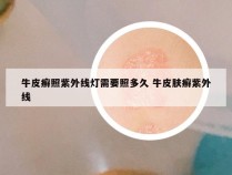 牛皮癣照紫外线灯需要照多久 牛皮肤癣紫外线