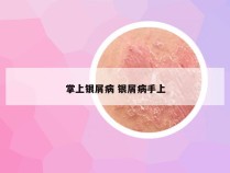 掌上银屑病 银屑病手上