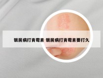 银屑病打青霉素 银屑病打青霉素要打久