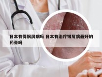日本有得银屑病吗 日本有治疗银屑病最好的药膏吗