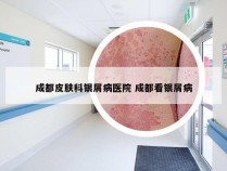 成都皮肤科银屑病医院 成都看银屑病