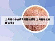 上海哪个牛皮癣专科医院最好 上海看牛皮癣医院排名