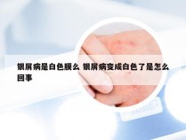银屑病是白色膜么 银屑病变成白色了是怎么回事