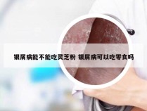银屑病能不能吃灵芝粉 银屑病可以吃零食吗