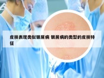 皮损表现类似银屑病 银屑病的类型的皮损特征