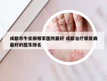 成都市牛皮癣哪家医院最好 成都治疗银屑病最好的医生排名