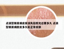 点滴型银屑病皮损消失后照光还要多久 点滴型银屑病脱皮多久能正常皮肤