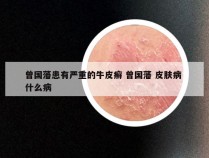 曾国藩患有严重的牛皮癣 曾国藩 皮肤病 什么病