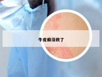 牛皮癣没救了