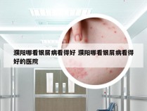 濮阳哪看银屑病看得好 濮阳哪看银屑病看得好的医院