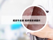 疱状牛皮癣 疱疹银屑病图片