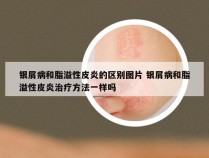 银屑病和脂溢性皮炎的区别图片 银屑病和脂溢性皮炎治疗方法一样吗