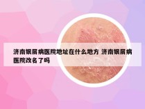 济南银屑病医院地址在什么地方 济南银屑病医院改名了吗