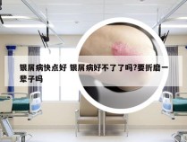 银屑病快点好 银屑病好不了了吗?要折磨一辈子吗