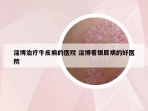 淄博治疗牛皮癣的医院 淄博看银屑病的好医院