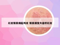 红皮银屑病起鸡皮 银屑病变大面积红皮